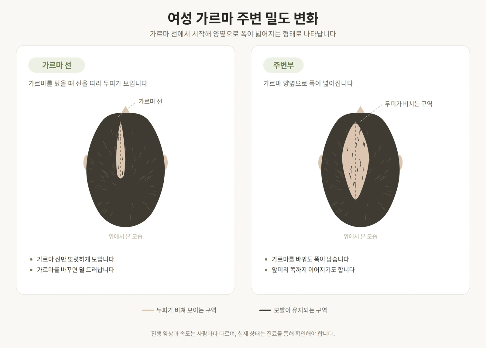 여성 가르마 선을 따라 두피가 비치는 구역이 넓어지는 과정을 위에서 본 도해