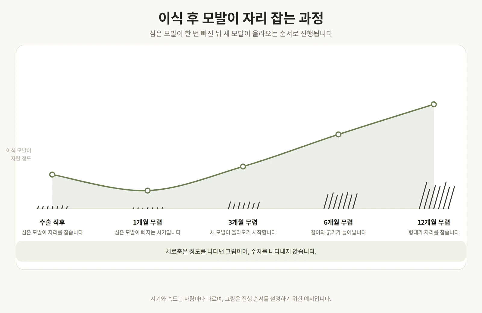 모발이식 후 수술 직후부터 12개월 무렵까지 이식 모발이 자리 잡는 단계를 나타낸 도해