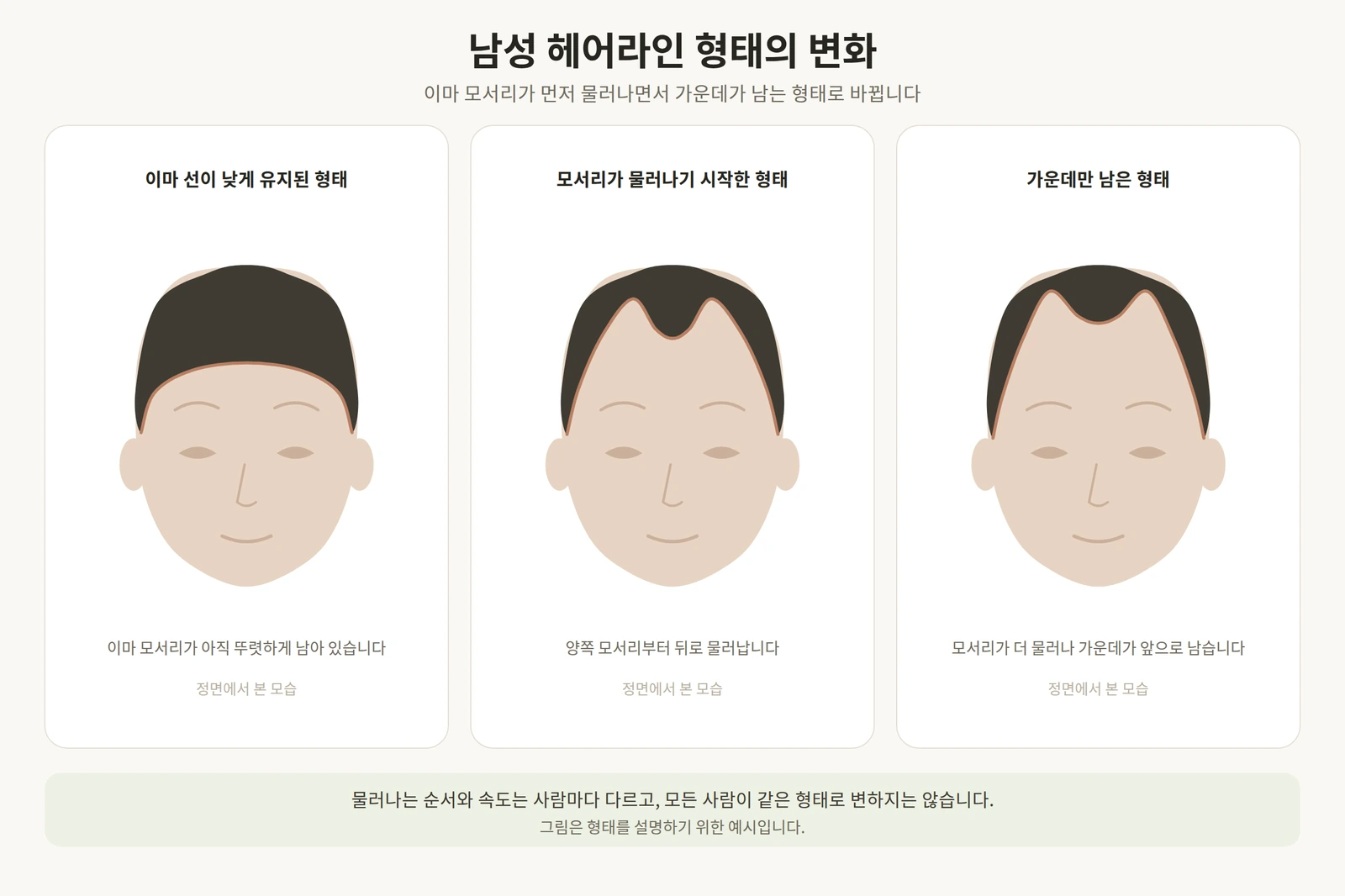 남성 헤어라인이 이마 모서리부터 물러나며 형태가 달라지는 과정을 단계별로 나타낸 도해