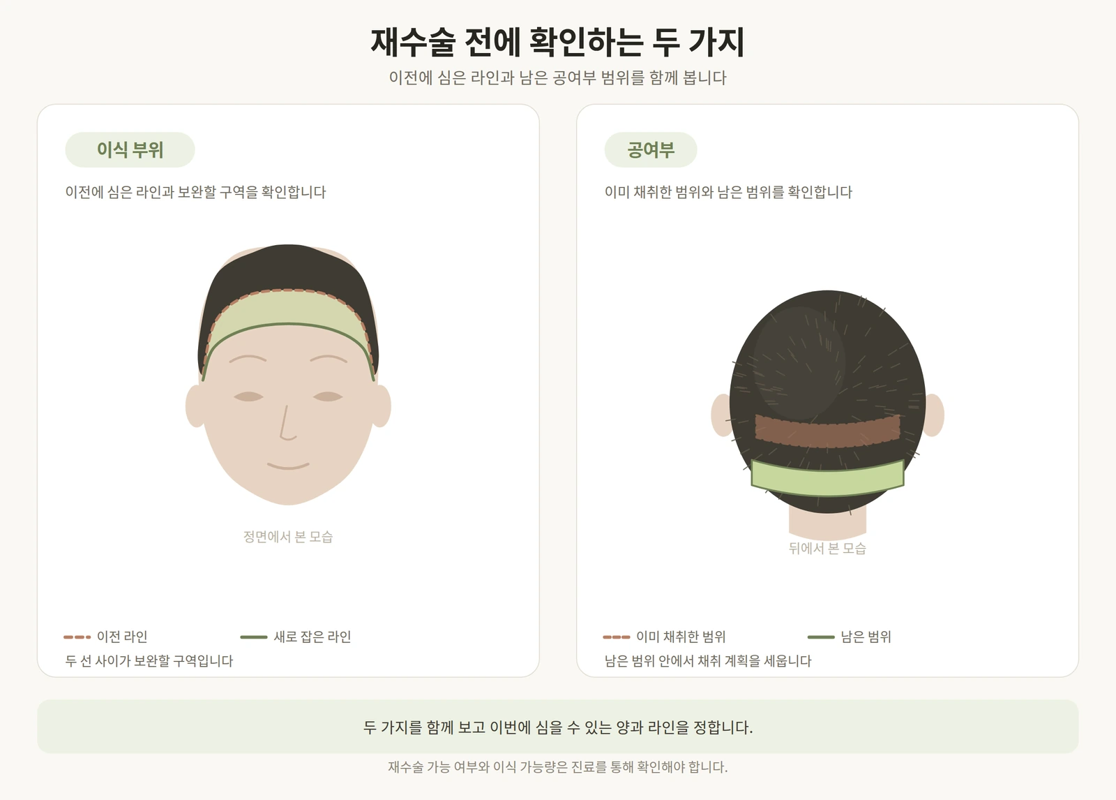 재수술 전에 확인하는 이전 이식 라인과 남은 공여부 범위를 함께 표시한 도해