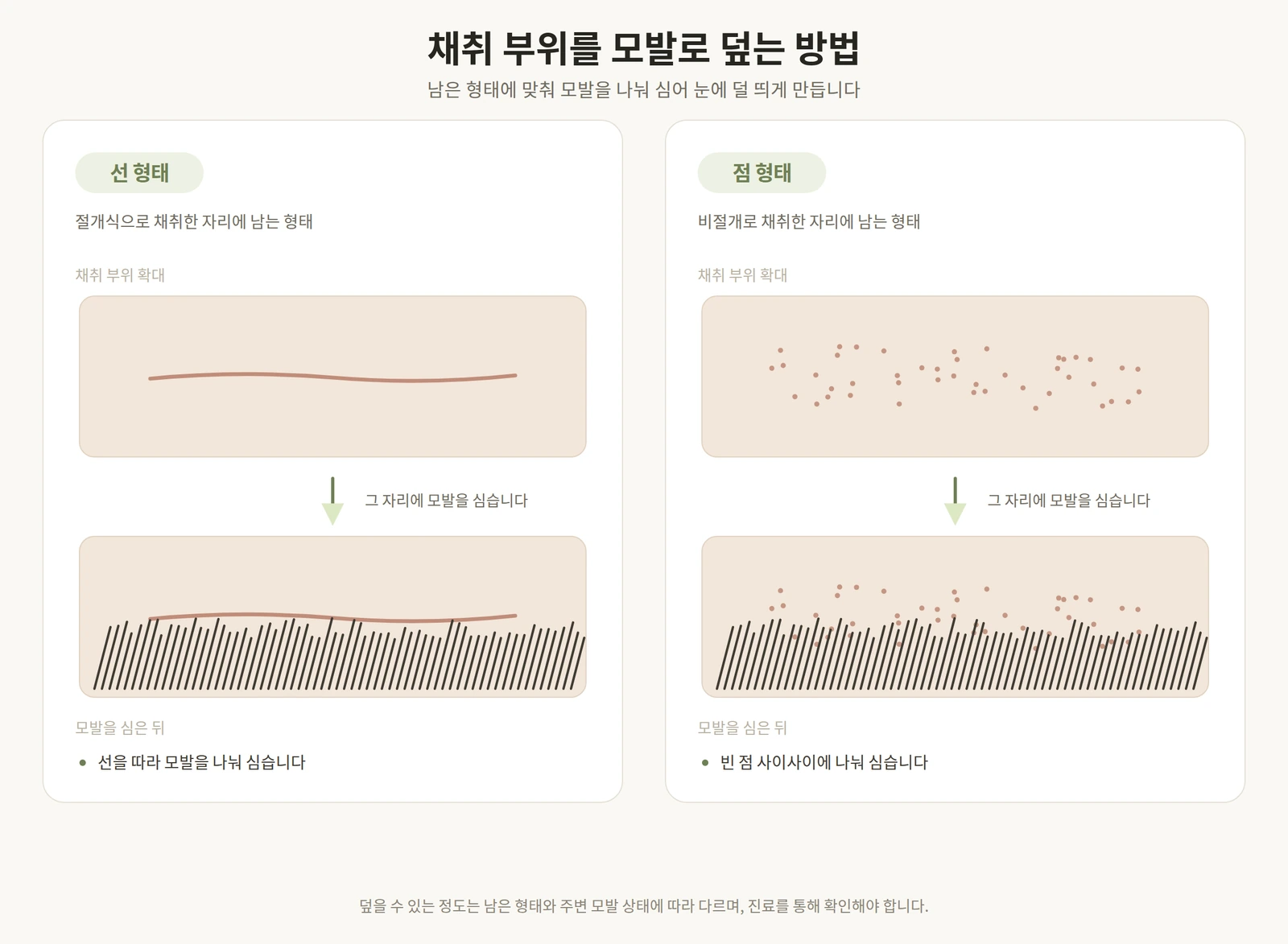 절개식의 선 형태와 비절개의 점 형태 채취 자리에 모발을 심어 덮는 방법을 비교한 도해