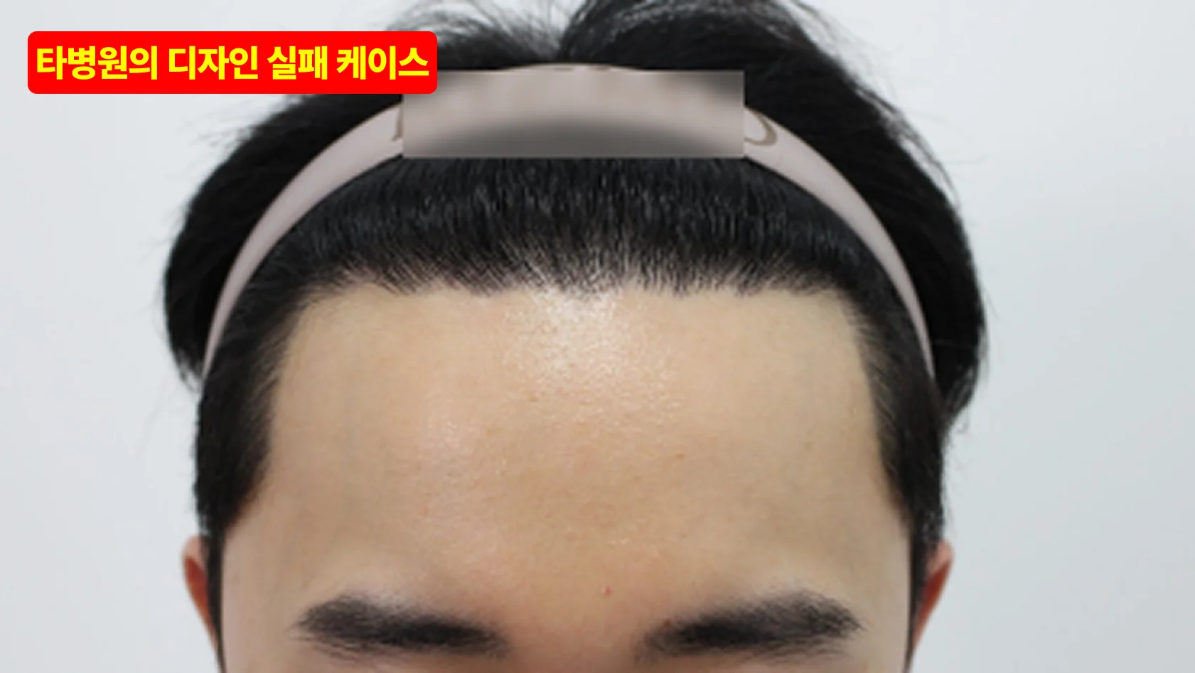 타원 시술 후 부자연스러운 남성 헤어라인 사례