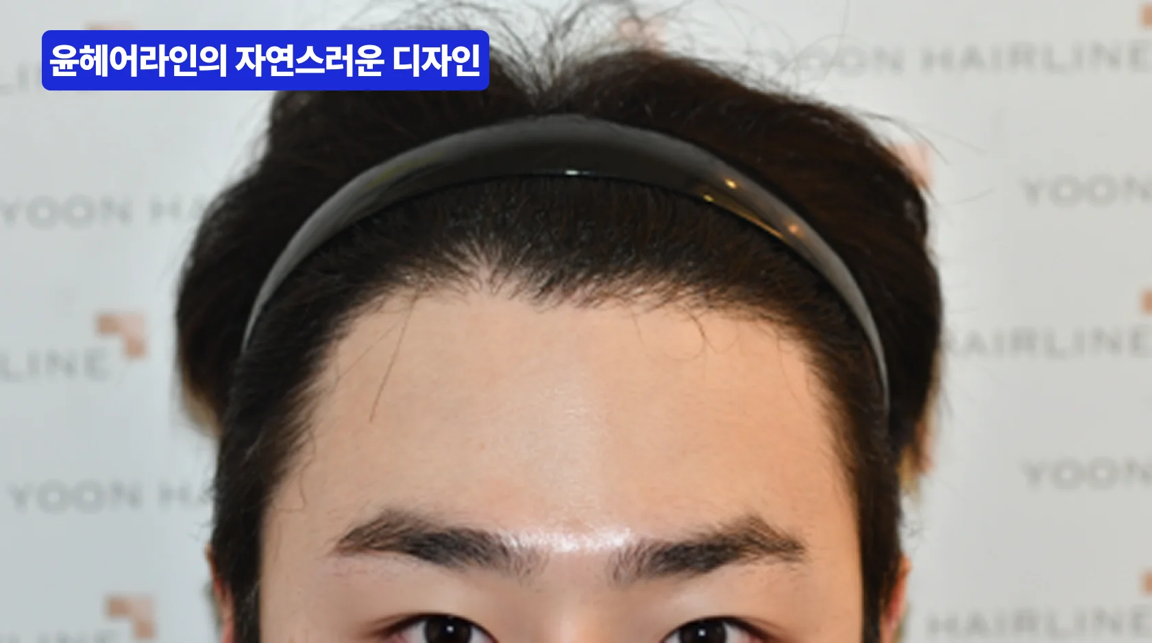 윤헤어라인의원의 남성 헤어라인 결과