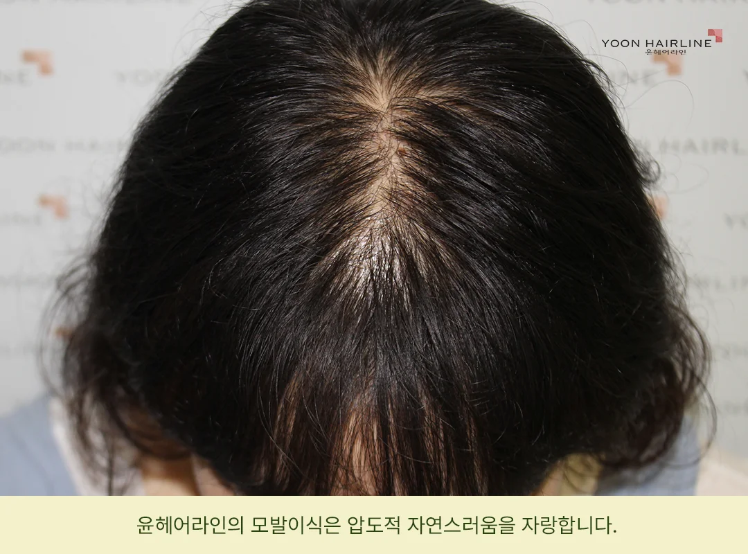 정수리 모발이식 후 가르마 부위 모습