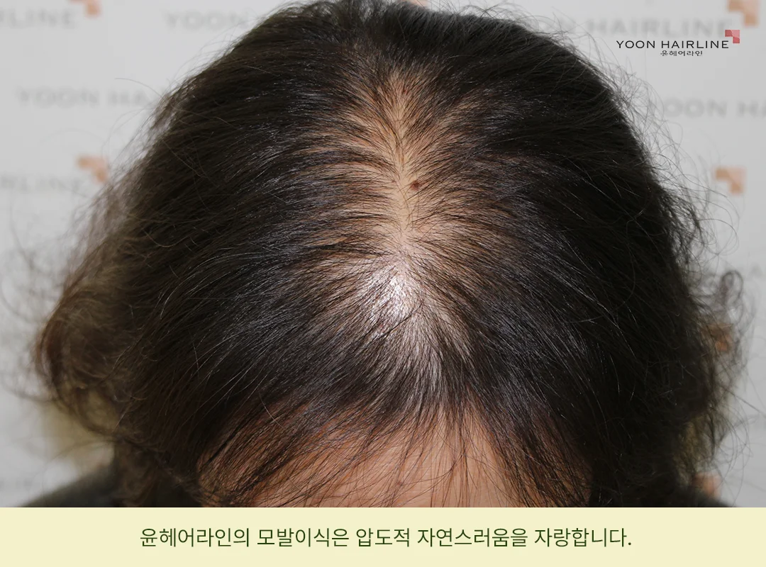 정수리 모발이식 전 가르마 부위 모습