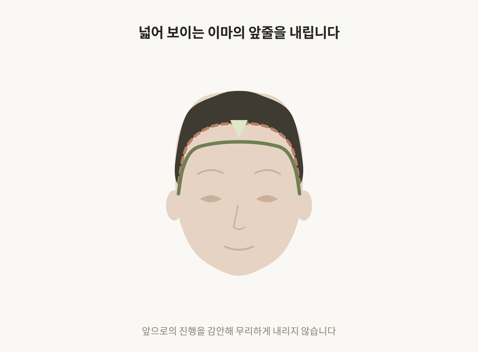 높아진 앞줄을 무리 없이 내리는 교정 도해