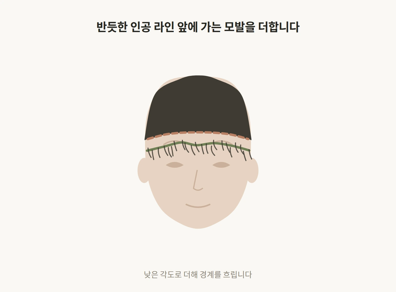기존 이식 라인 앞에 가는 모발을 더해 경계를 흐리는 교정 도해