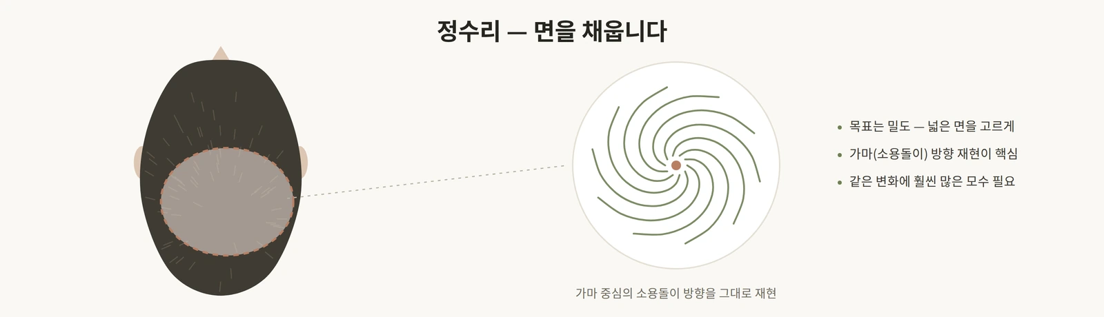 정수리 모발이식은 가마 방향대로 면을 채우는 작업임을 설명하는 도해