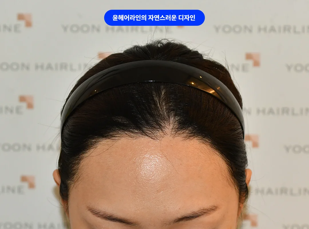 정면에서 본 여성 헤어라인의 자연스러운 앞줄