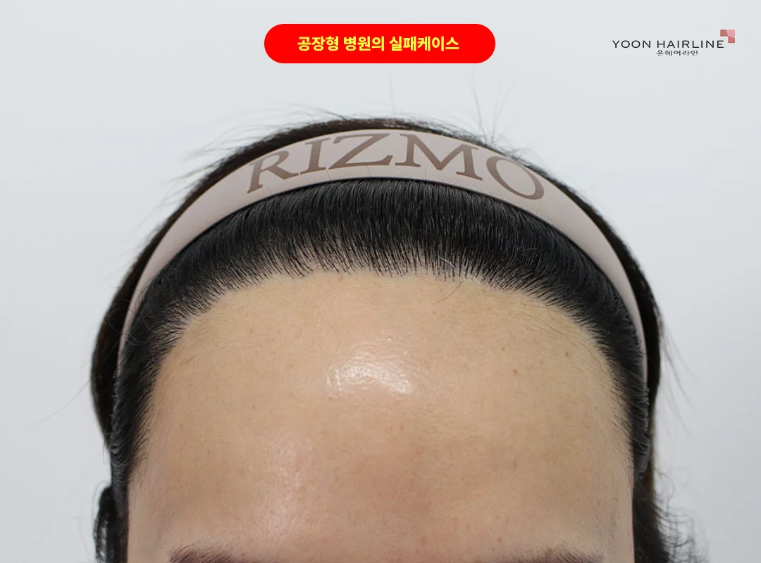 앞줄이 일정한 간격으로 서 있는 타원 시술 사례