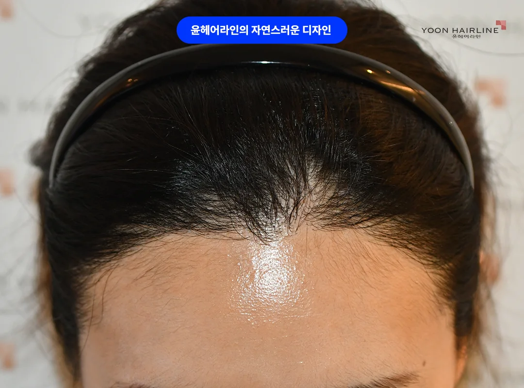 재수술 후 헤어라인 앞줄 모습