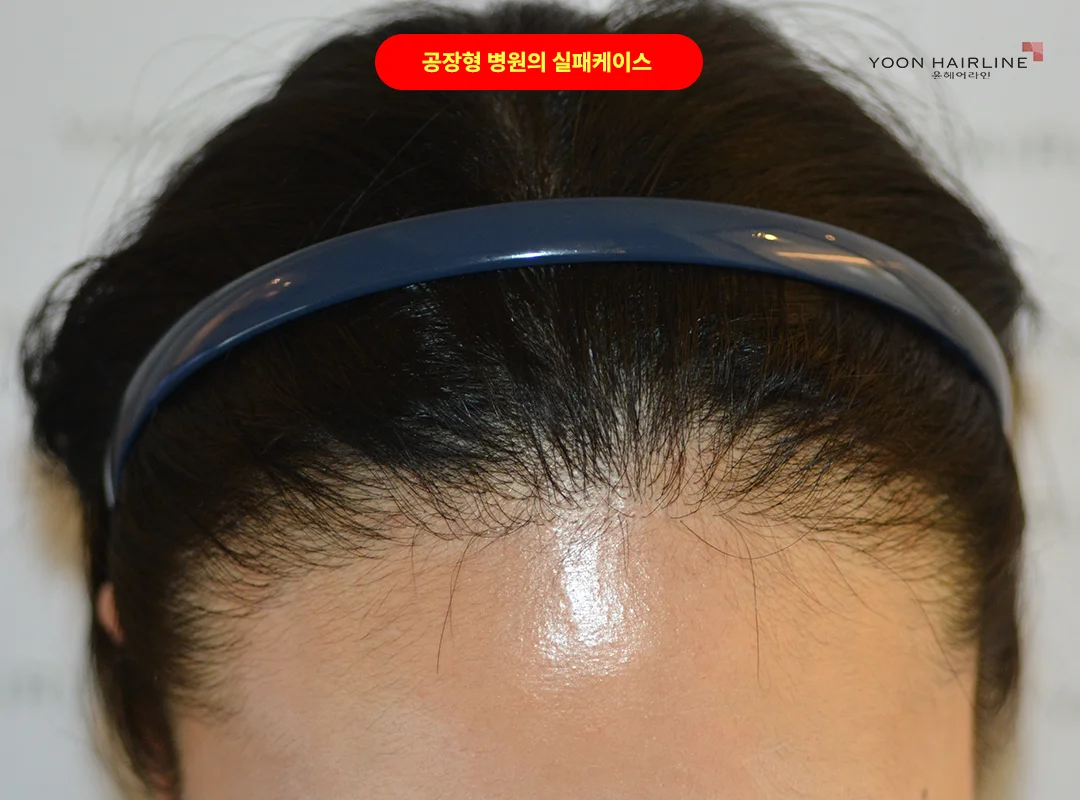 재수술 전 헤어라인 앞줄 모습